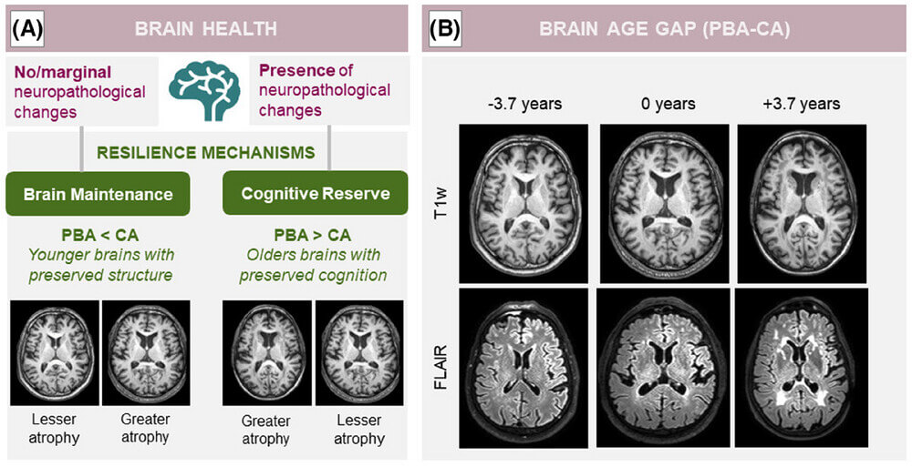 Lifestyle Influences Brain Resilience Among Aging Population